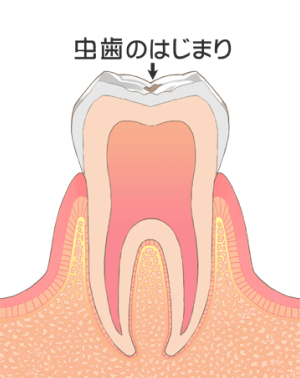 C0：歯の表面が溶け始めたごく初期の虫歯