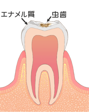 C1：虫歯が歯の表面のエナメル質に留まっている状態