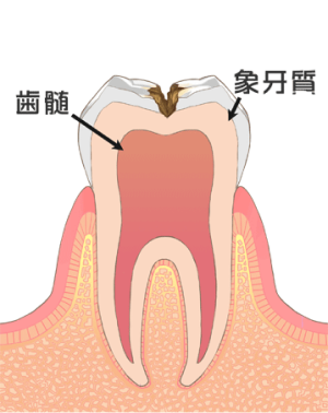 C2：虫歯が象牙質にまで及んだ状態