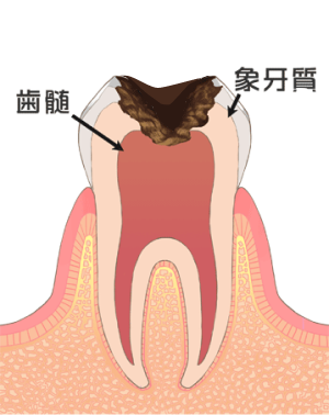 C3：血管まで侵された状態