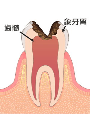 C3：血管まで侵された状態