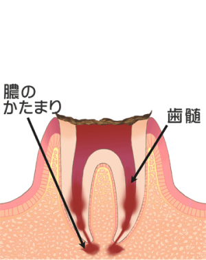 C4：歯の根だけが残った虫歯の最終段階